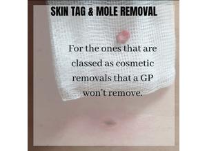 Skin tag removal registered nurse